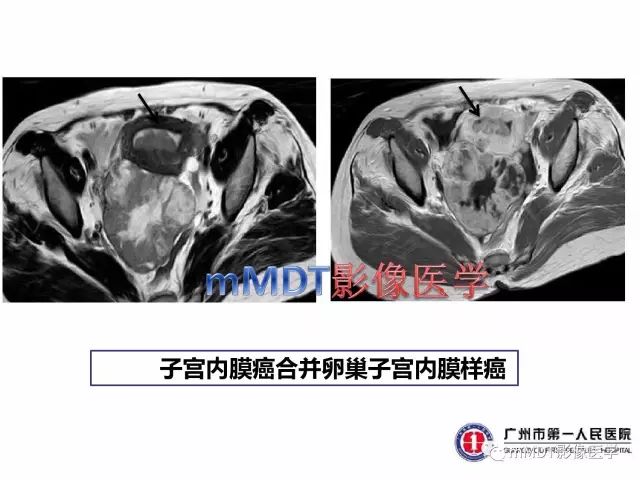 【病例】卵巢PNET1例CT及MR
