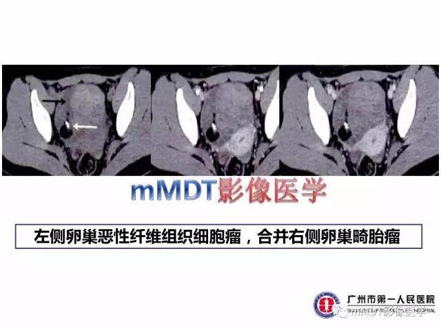【病例】卵巢PNET1例CT及MR