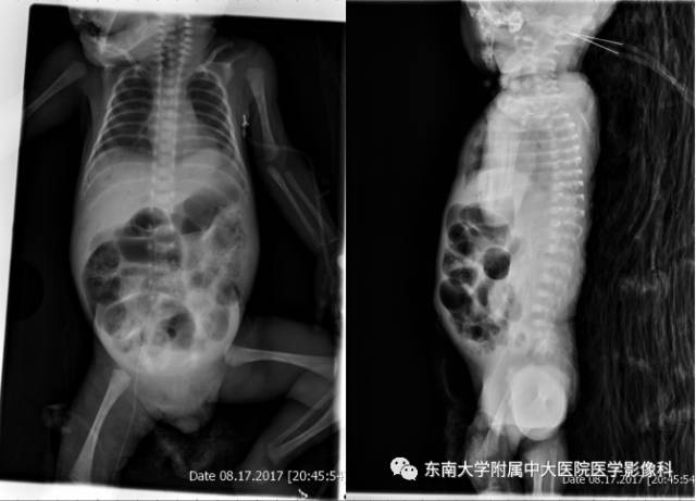 【病例】新生儿坏死性肠炎1例X线CT影像表现