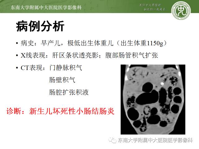【病例】新生儿坏死性肠炎1例X线CT影像表现
