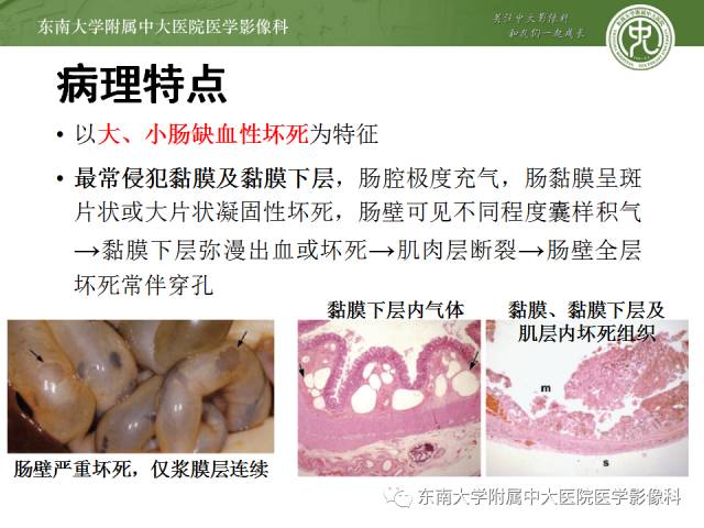 【病例】新生儿坏死性肠炎1例X线CT影像表现
