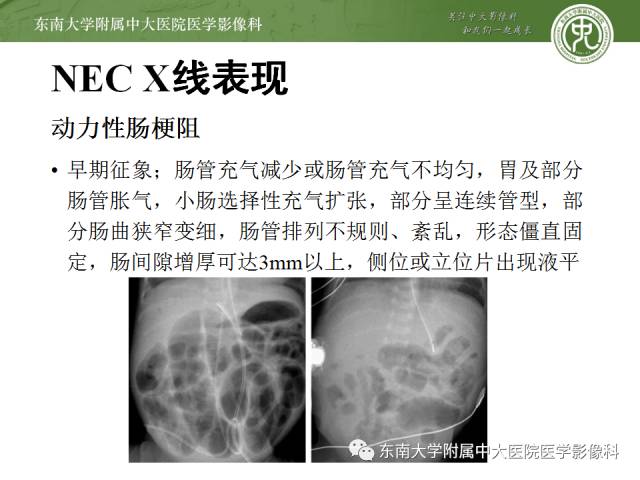 【病例】新生儿坏死性肠炎1例X线CT影像表现