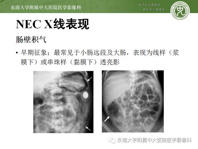 【病例】新生儿坏死性肠炎1例X线CT影像表现