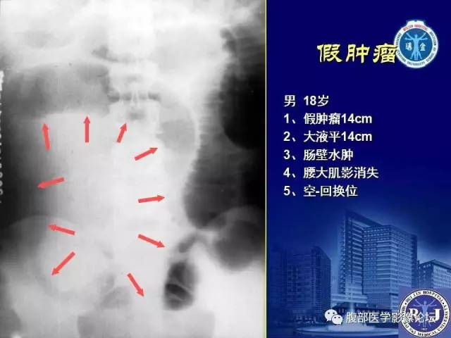 【PPT】急性绞窄性肠梗阻CT诊断