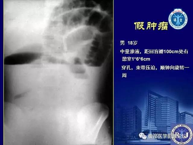 【PPT】急性绞窄性肠梗阻CT诊断