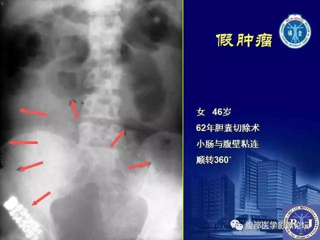【PPT】急性绞窄性肠梗阻CT诊断