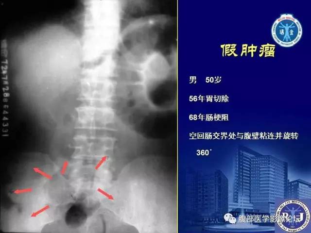 【PPT】急性绞窄性肠梗阻CT诊断