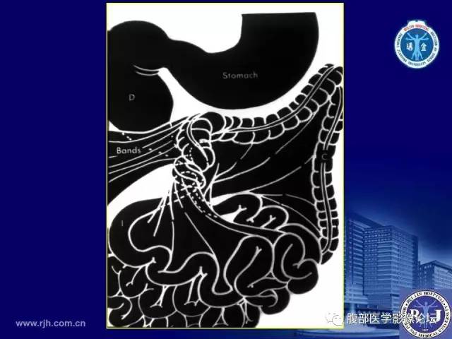 【PPT】急性绞窄性肠梗阻CT诊断