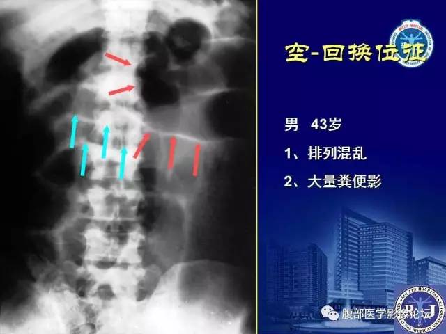【PPT】急性绞窄性肠梗阻CT诊断