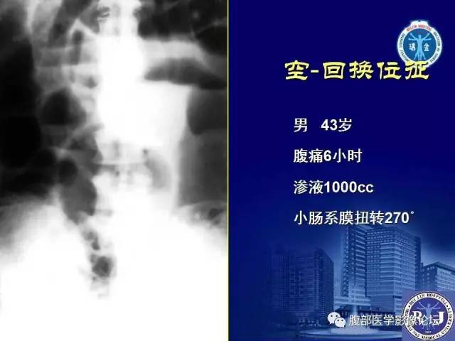 【PPT】急性绞窄性肠梗阻CT诊断