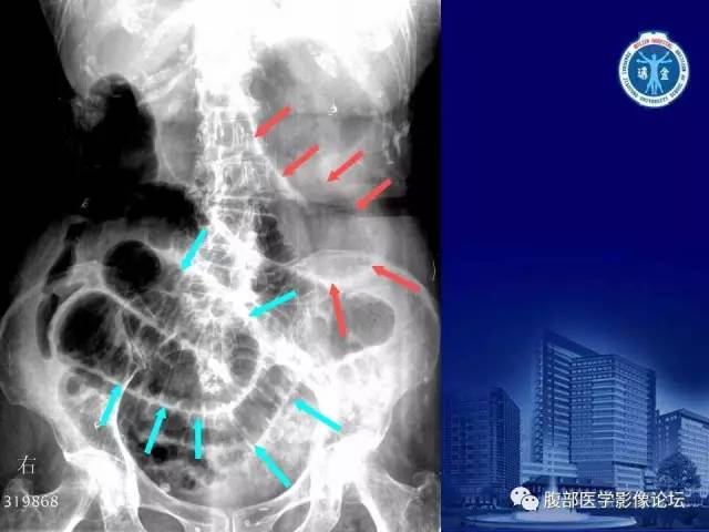 【PPT】急性绞窄性肠梗阻CT诊断