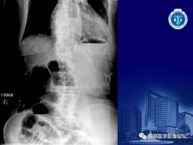 【PPT】急性绞窄性肠梗阻CT诊断