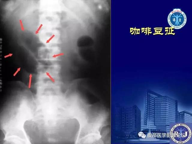【PPT】急性绞窄性肠梗阻CT诊断