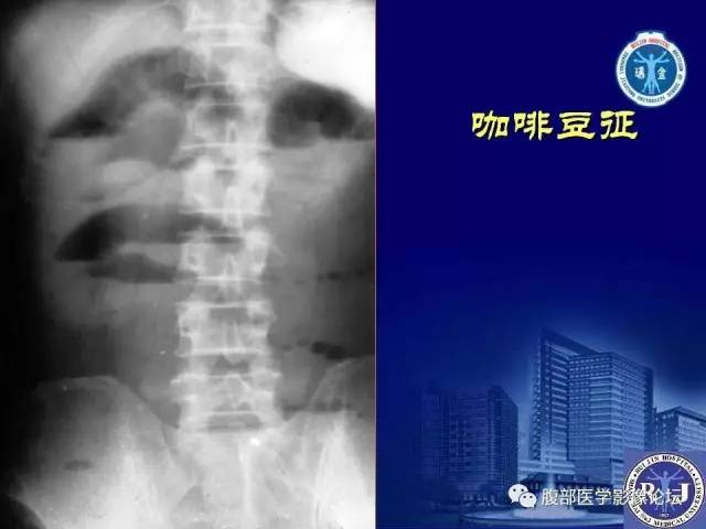 【PPT】急性绞窄性肠梗阻CT诊断