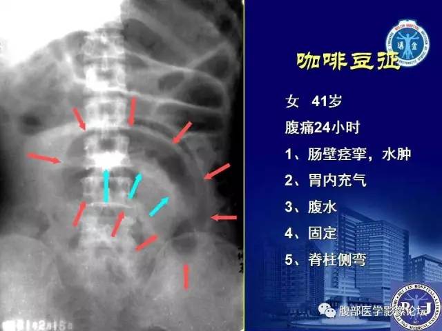 【PPT】急性绞窄性肠梗阻CT诊断