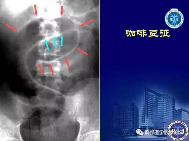 【PPT】急性绞窄性肠梗阻CT诊断