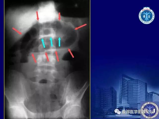 【PPT】急性绞窄性肠梗阻CT诊断