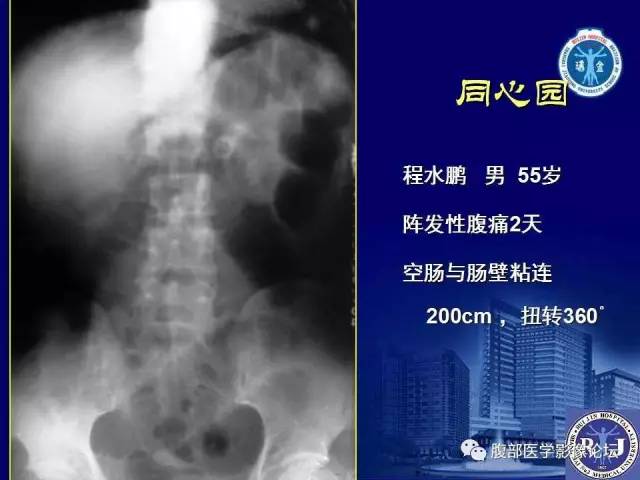 【PPT】急性绞窄性肠梗阻CT诊断