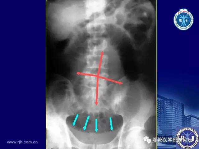 【PPT】急性绞窄性肠梗阻CT诊断