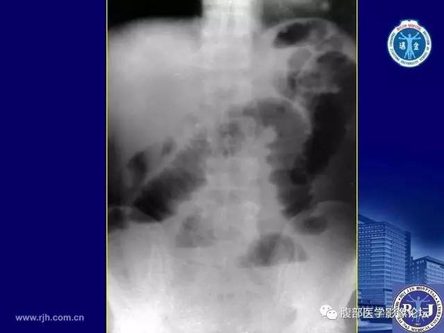【PPT】急性绞窄性肠梗阻CT诊断