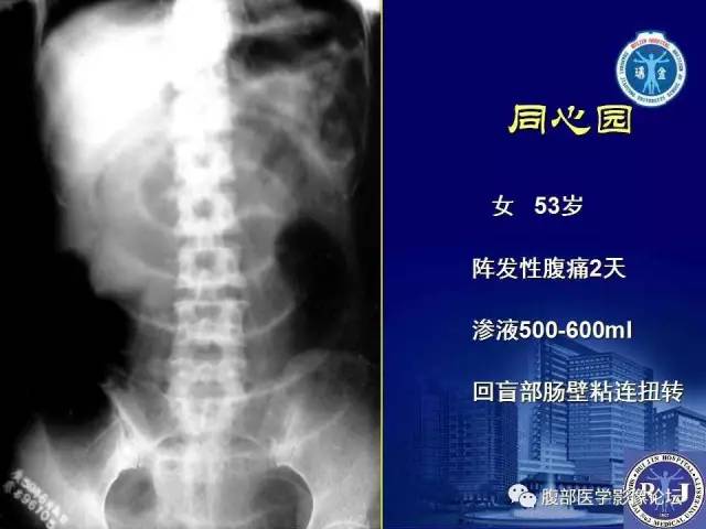 【PPT】急性绞窄性肠梗阻CT诊断