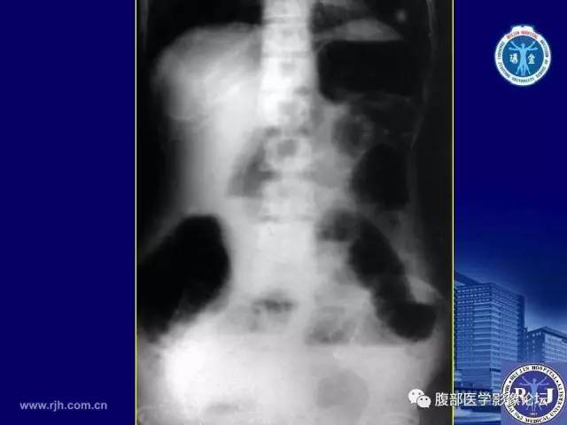 【PPT】急性绞窄性肠梗阻CT诊断