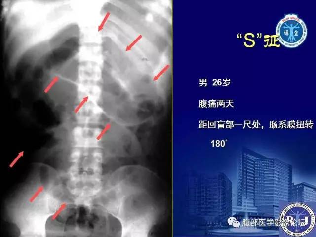【PPT】急性绞窄性肠梗阻CT诊断