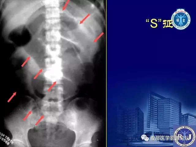 【PPT】急性绞窄性肠梗阻CT诊断