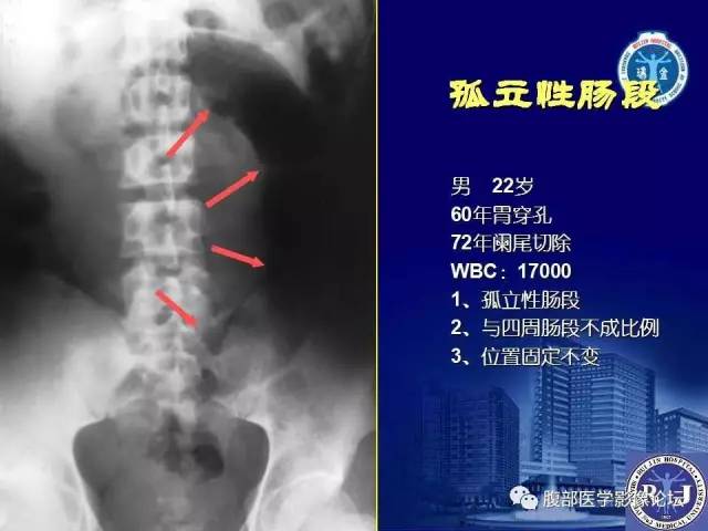 【PPT】急性绞窄性肠梗阻CT诊断