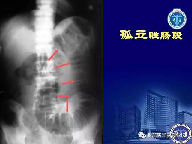 【PPT】急性绞窄性肠梗阻CT诊断