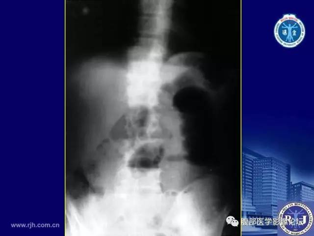 【PPT】急性绞窄性肠梗阻CT诊断