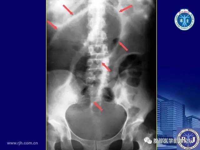 【PPT】急性绞窄性肠梗阻CT诊断