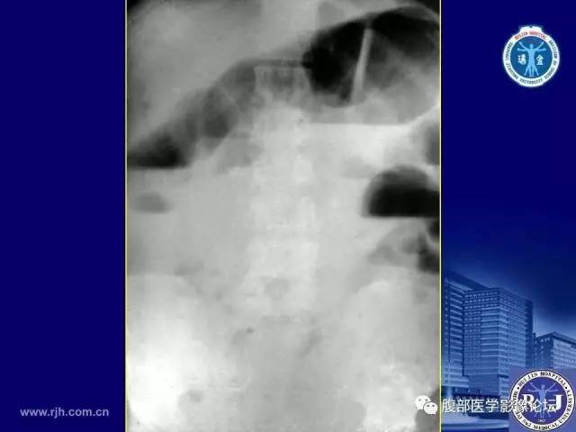【PPT】急性绞窄性肠梗阻CT诊断