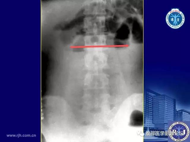 【PPT】急性绞窄性肠梗阻CT诊断
