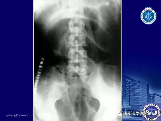【PPT】急性绞窄性肠梗阻CT诊断