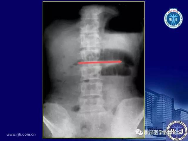 【PPT】急性绞窄性肠梗阻CT诊断