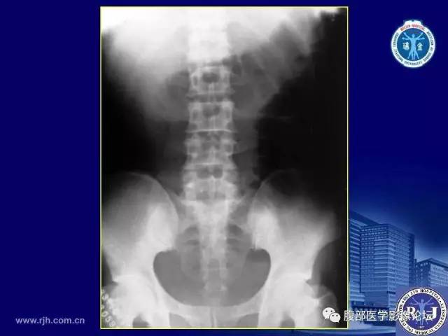 【PPT】急性绞窄性肠梗阻CT诊断