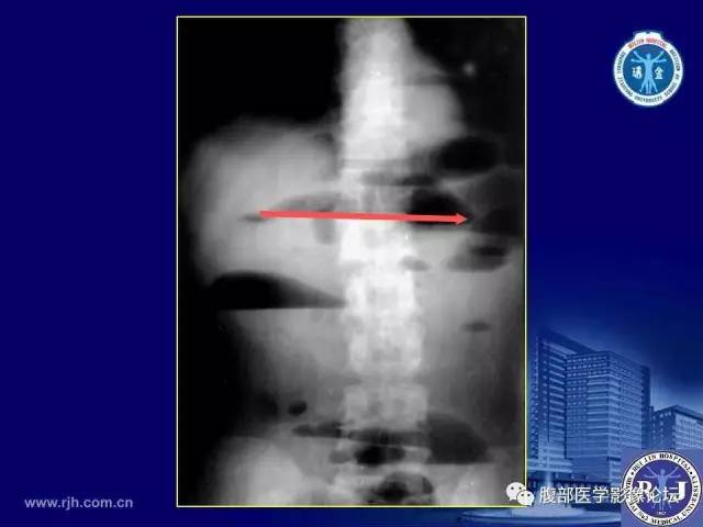 【PPT】急性绞窄性肠梗阻CT诊断