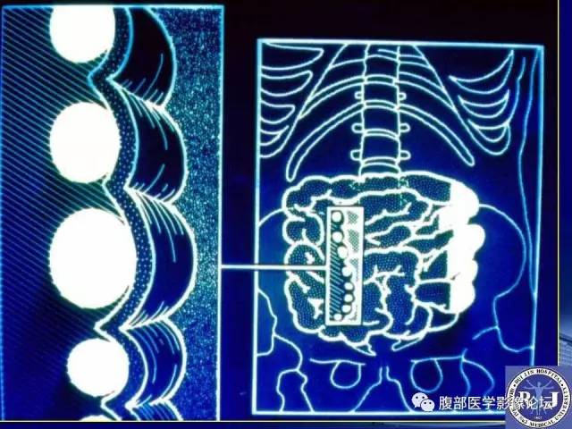 【PPT】急性绞窄性肠梗阻CT诊断