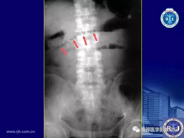 【PPT】急性绞窄性肠梗阻CT诊断