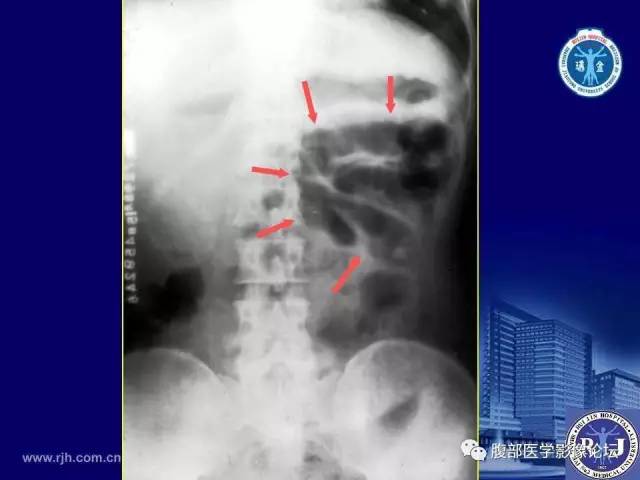 【PPT】急性绞窄性肠梗阻CT诊断