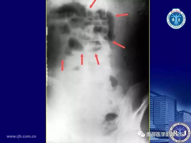 【PPT】急性绞窄性肠梗阻CT诊断