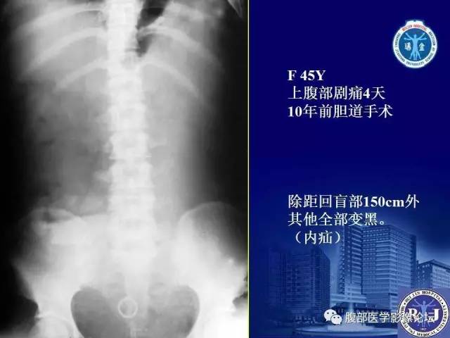 【PPT】急性绞窄性肠梗阻CT诊断
