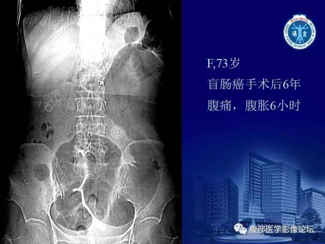 【PPT】急性绞窄性肠梗阻CT诊断