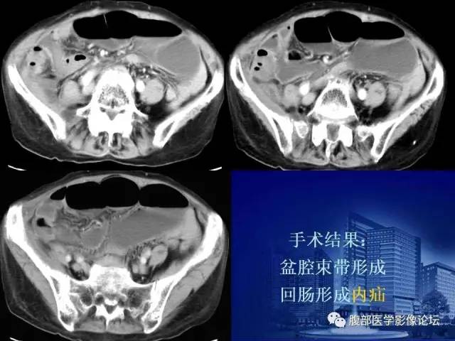 【PPT】急性绞窄性肠梗阻CT诊断