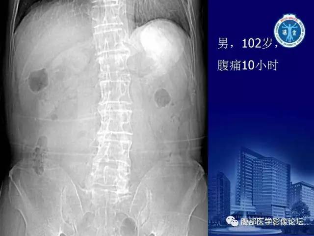 【PPT】急性绞窄性肠梗阻CT诊断