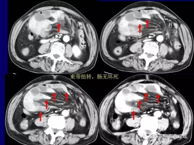 【PPT】急性绞窄性肠梗阻CT诊断
