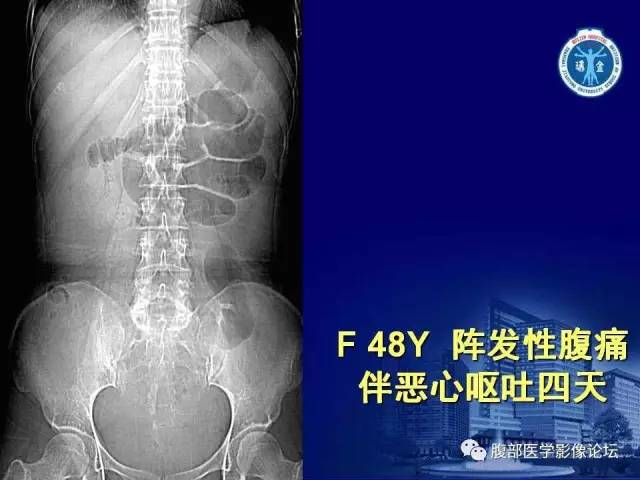 【PPT】急性绞窄性肠梗阻CT诊断