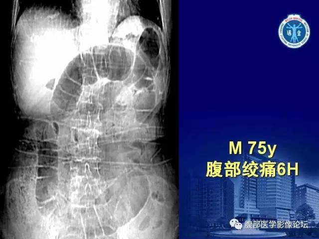 【PPT】急性绞窄性肠梗阻CT诊断