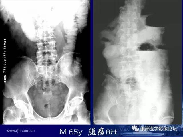 【PPT】急性绞窄性肠梗阻CT诊断